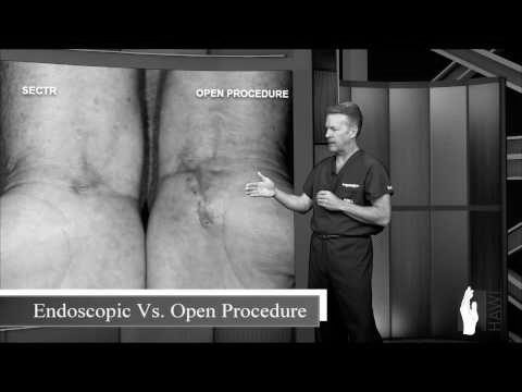 Title frame of our video comparing open and endoscopic carpal tunnel release.